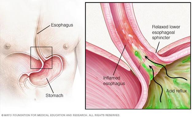 Understanding GERD: Causes, Symptoms, and Solutions